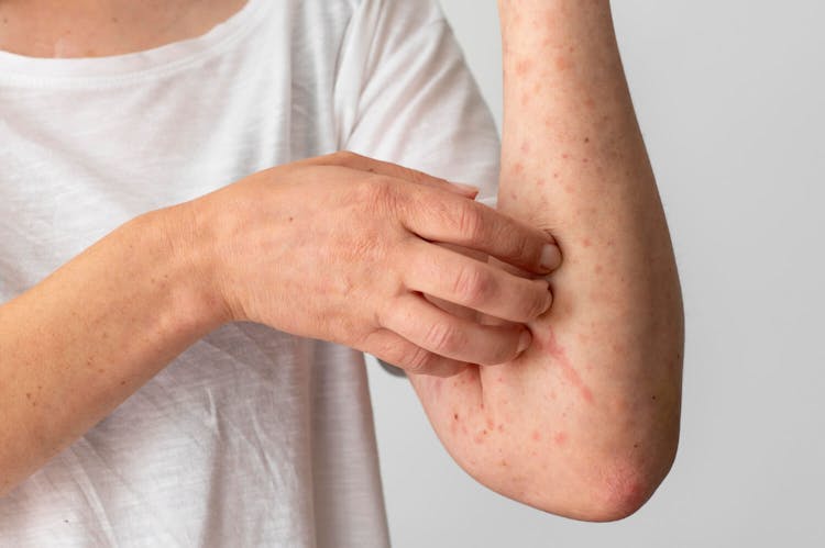 Dermatite: causas, tratamentos e sintomas
