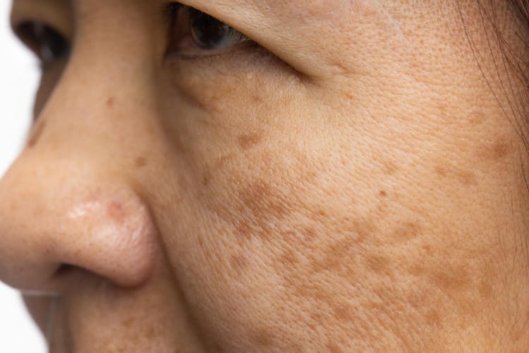 Manchas na pele: tipos, causas e tratamentos